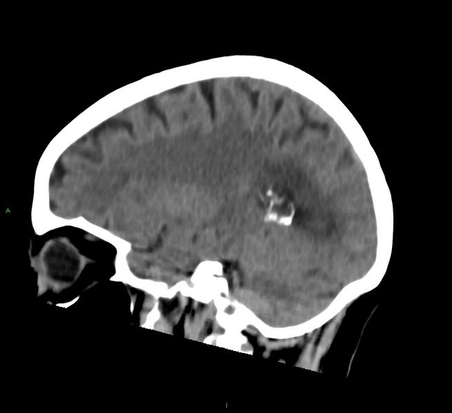 File:Cerebral amyloid angiopathy-associated lobar intracerebral hemorrhage (Radiopaedia 58757-65978 C 36).jpg