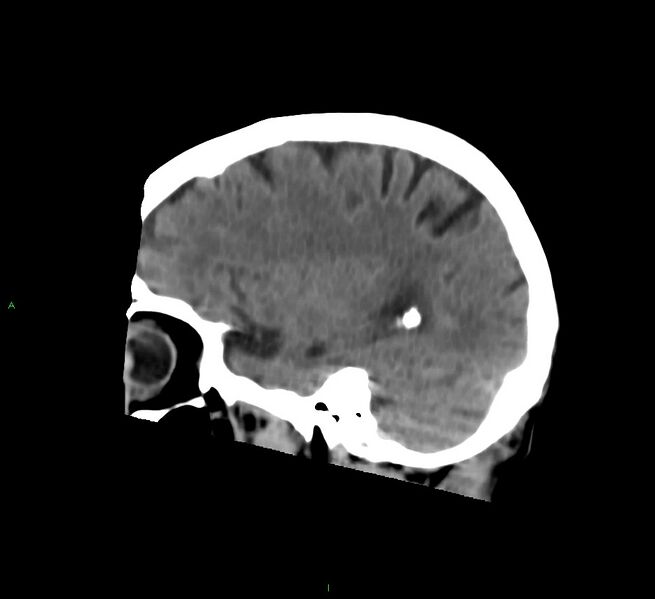 File:Cerebral amyloid angiopathy-associated lobar intracerebral hemorrhage (Radiopaedia 58758-65980 C 39).jpg