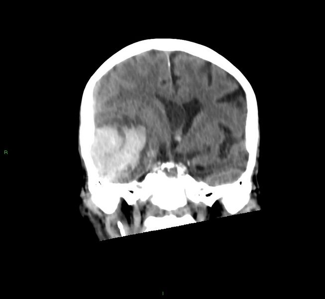 File:Cerebral amyloid angiopathy-associated lobar intracerebral hemorrhage (Radiopaedia 58758-65980 Coronal non-contrast 36).jpg