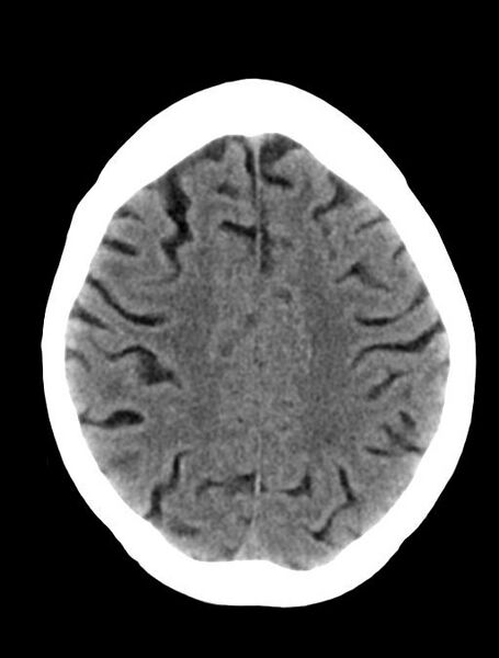 File:Cerebral aneurysm with rupture (Radiopaedia 29933-30457 Axial non-contrast 19).jpg