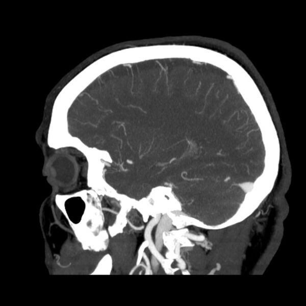 File:Cerebral arteriovenous malformation (Radiopaedia 43729-47189 D 14).jpg