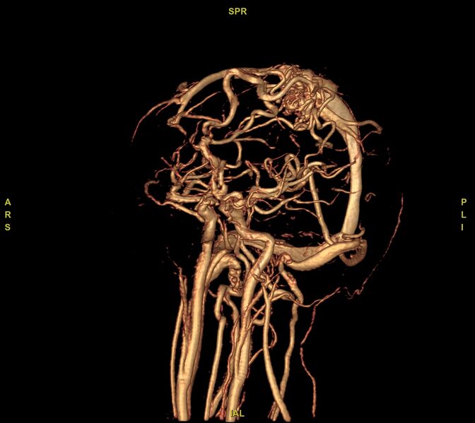 File:Cerebral arteriovenous malformation (Radiopaedia 61964-70029 VRT 47).jpg