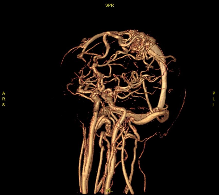 Cerebral arteriovenous malformation (Radiopaedia 61964-70029 VRT 47).jpg