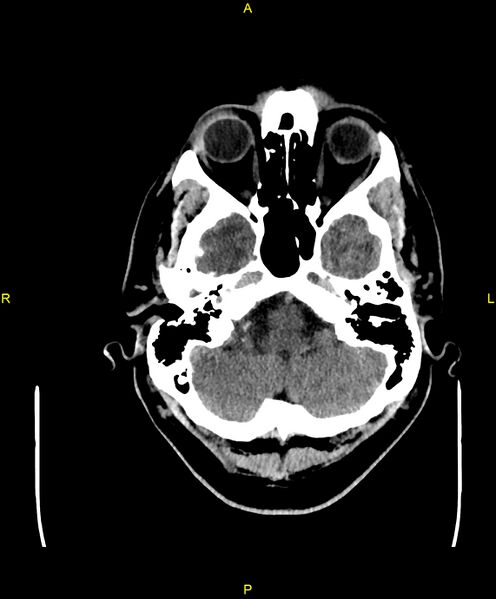 File:Cerebral autosomal dominant arteriopathy with subcortical infarcts and leukoencephalopathy (CADASIL) (Radiopaedia 86108-102051 Axial non-contrast 17).jpg