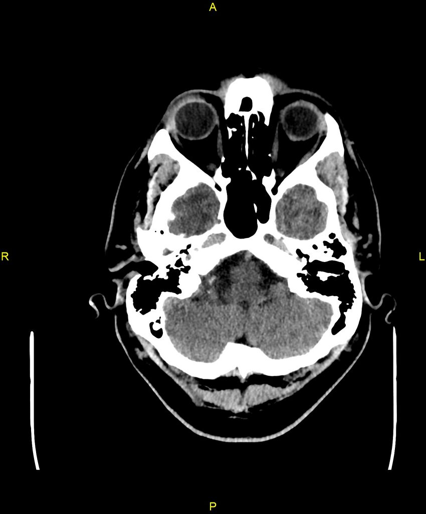 Cerebral autosomal dominant arteriopathy with subcortical infarcts and leukoencephalopathy (CADASIL) (Radiopaedia 86108-102051 Axial non-contrast 17).jpg