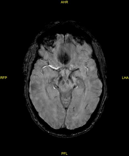 File:Cerebral autosomal dominant arteriopathy with subcortical infarcts and leukoencephalopathy (CADASIL) (Radiopaedia 86108-102054 Axial SWI 48).jpg