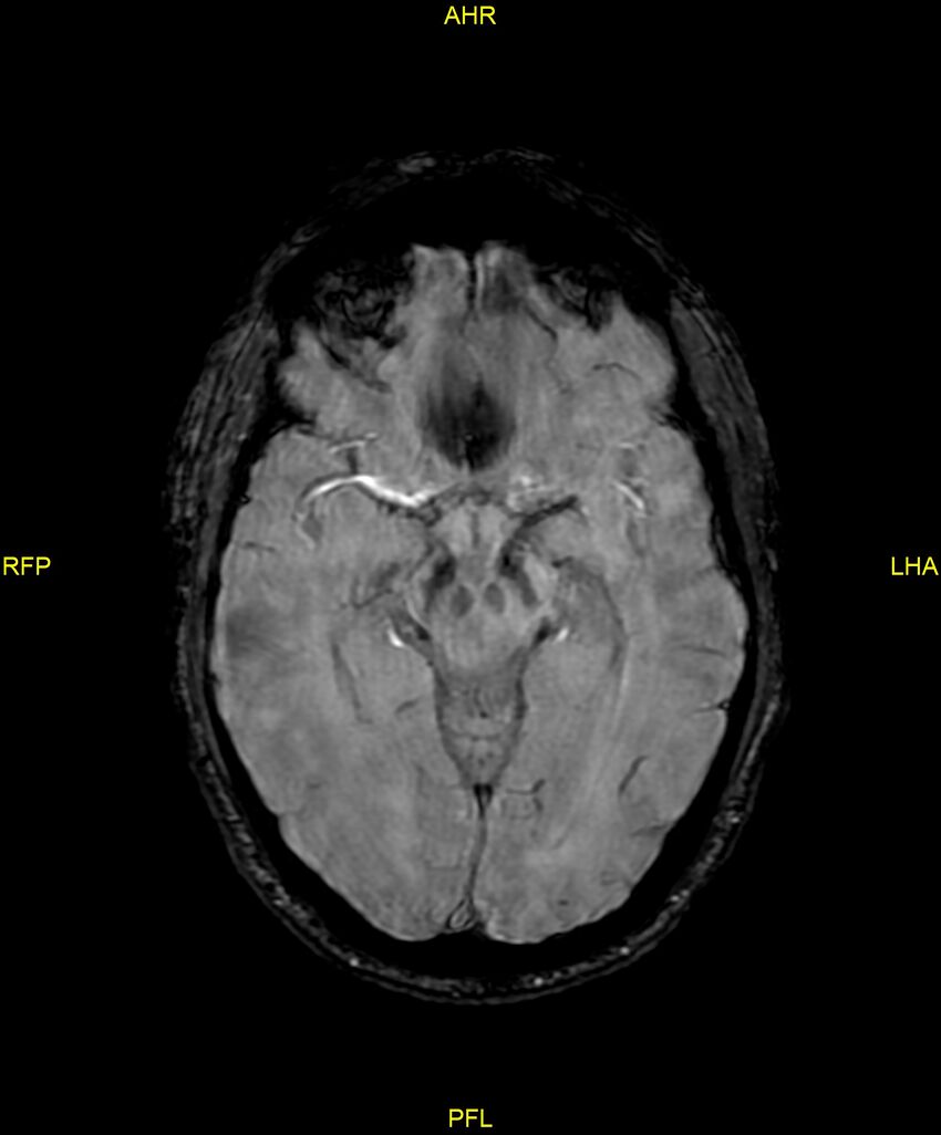Cerebral autosomal dominant arteriopathy with subcortical infarcts and leukoencephalopathy (CADASIL) (Radiopaedia 86108-102054 Axial SWI 48).jpg