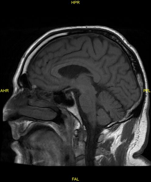 File:Cerebral autosomal dominant arteriopathy with subcortical infarcts and leukoencephalopathy (CADASIL) (Radiopaedia 86108-102054 Sagittal T1 15).jpg