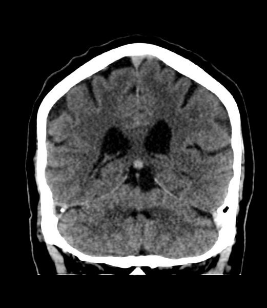 File:Cerebral dural venous sinus thrombosis (Radiopaedia 86514-102575 Coronal non-contrast 34).jpg