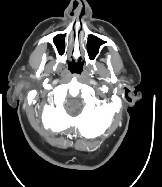 File:Cerebral dural venous sinus thrombosis (Radiopaedia 86514-102576 A 23).jpg
