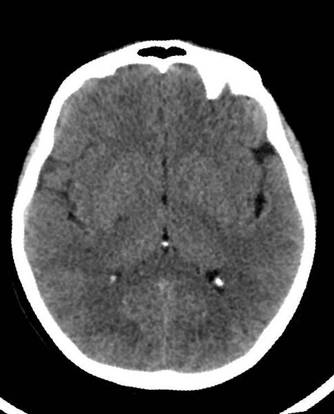 File:Cerebral edema due to severe hyponatremia (Radiopaedia 89826-106938 Axial non-contrast 52).jpg