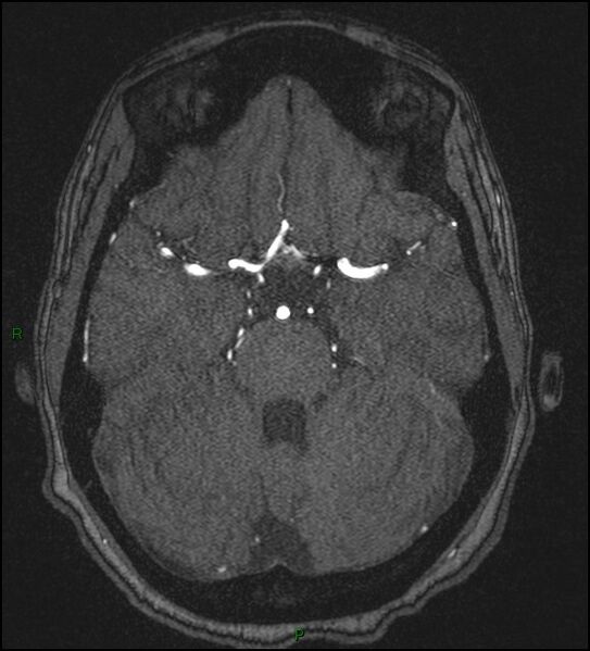 File:Cerebral fat embolism (Radiopaedia 35022-36525 Axial TOF 66).jpg