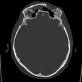 Cerebral hemorrhagic contusions (Radiopaedia 23145-23188 Axial bone window 23).jpg