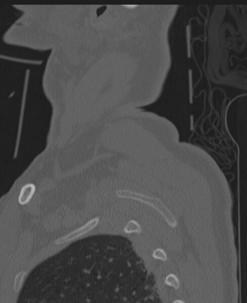 File:Cerebral hemorrhagic contusions and cervical spine fractures (Radiopaedia 32865-33841 Sagittal bone window 98).jpg
