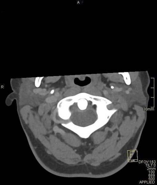 File:Cerebral venous sinus thrombosis (Radiopaedia 91329-108965 Axial venogram 5).jpg