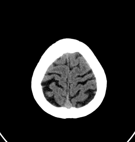 File:Cerebral venous thrombosis - CT only (Radiopaedia 41031-43778 Axial non-contrast 5).jpg