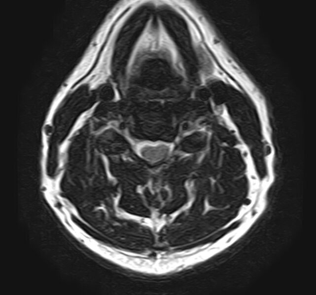 File:Cervical compressive myelopathy (Radiopaedia 71956-82411 Axial T2 3).jpg