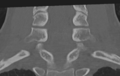 Cervical disc replacement (Radiopaedia 37383-39205 Coronal bone window 39).png