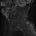 Cervical flexion teardrop fracture with cord hemorrhage (Radiopaedia 32497-33455 Sagittal STIR 19).jpg