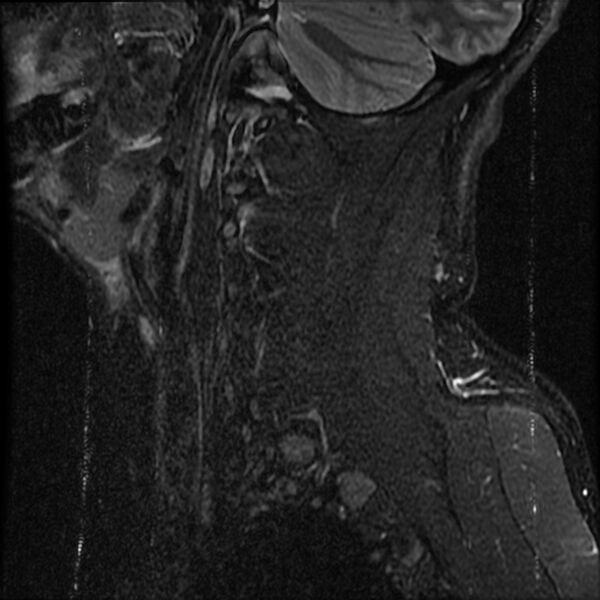 File:Cervical flexion teardrop fracture with cord hemorrhage (Radiopaedia 32497-33455 Sagittal STIR 19).jpg