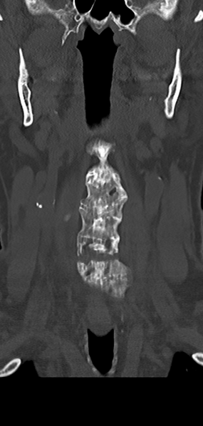 File:Cervical spine fracture - chalk stick (Radiopaedia 39116-41323 Coronal bone window 12).png