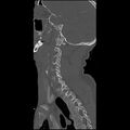 Cervical spine fractures with vertebral artery dissection (Radiopaedia 32135-33078 Sagittal bone window 10).jpg