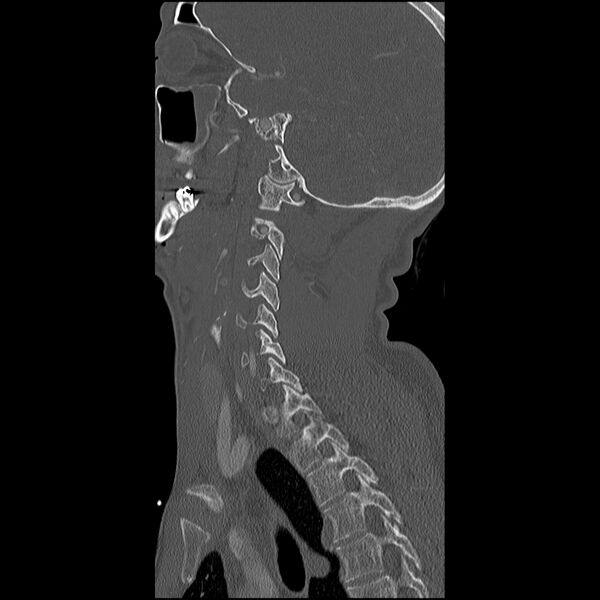 File:Cervical spine fractures with vertebral artery dissection (Radiopaedia 32135-33078 Sagittal bone window 10).jpg