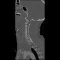 Cervical spine fractures with vertebral artery dissection (Radiopaedia 32135-33078 Sagittal bone window 26).jpg