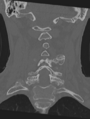 Cervical spondylolysis (Radiopaedia 49616-54811 Coronal bone window 30).png