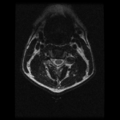 Cervical vertebrae metastasis (Radiopaedia 78814-91667 Axial T2 14).png