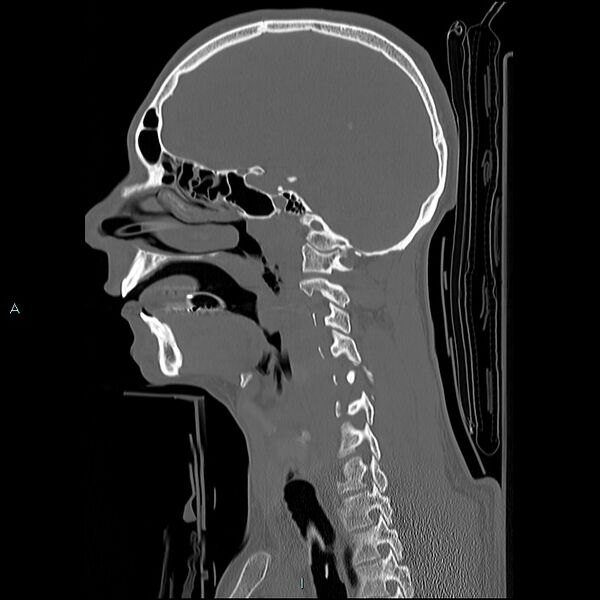 File:Cervical vertebral burst fracture (Radiopaedia 37420-39258 Sagittal bone window 22).jpg