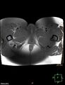 Cesarian scar endometriosis (Radiopaedia 68495-78066 Axial T1 fat sat 29).jpg