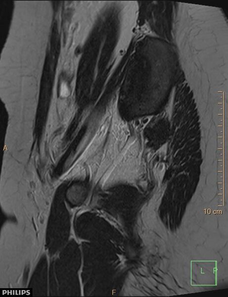 File:Cesarian scar endometriosis (Radiopaedia 68495-78066 Sagittal T2 3).jpg