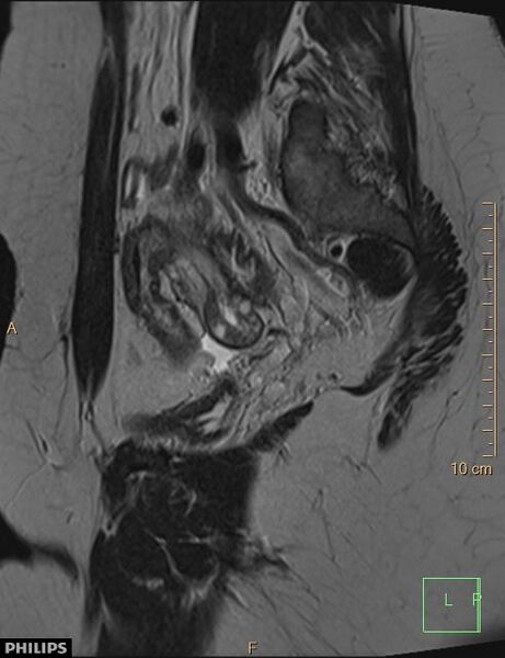 File:Cesarian scar endometriosis (Radiopaedia 68495-78066 Sagittal T2 7).jpg