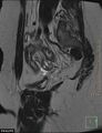 Cesarian scar endometriosis (Radiopaedia 68495-78066 Sagittal T2 7).jpg