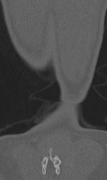 File:Chance fracture (Radiopaedia 40360-42912 Coronal bone window 72).png