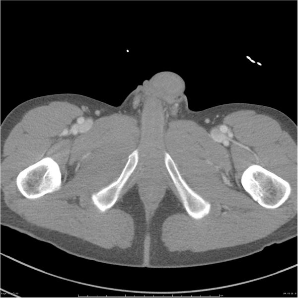 File:Chest and abdomen multi-trauma (Radiopaedia 26294-26426 bone window 95).jpg
