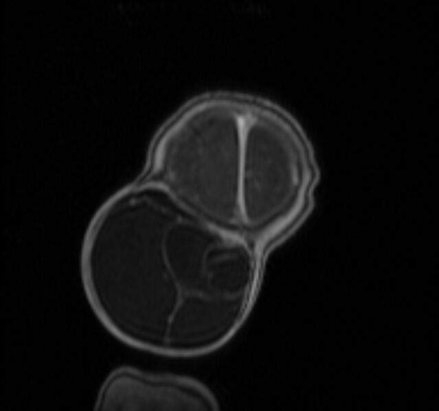 File:Chiari III malformation with occipital encephalocele (Radiopaedia 79446-92559 Coronal T1 C+ mpr 49).jpg