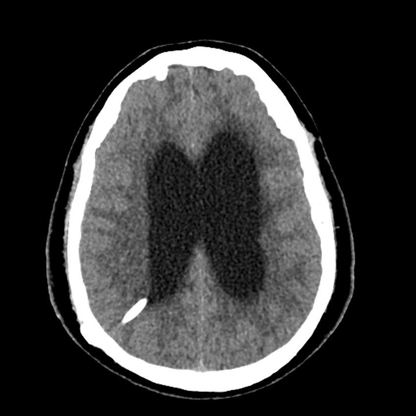 Chiasmatic-hypothalamic juvenile pilocytic astrocytoma (Radiopaedia 78533-91237 Axial non-contrast 39).jpg