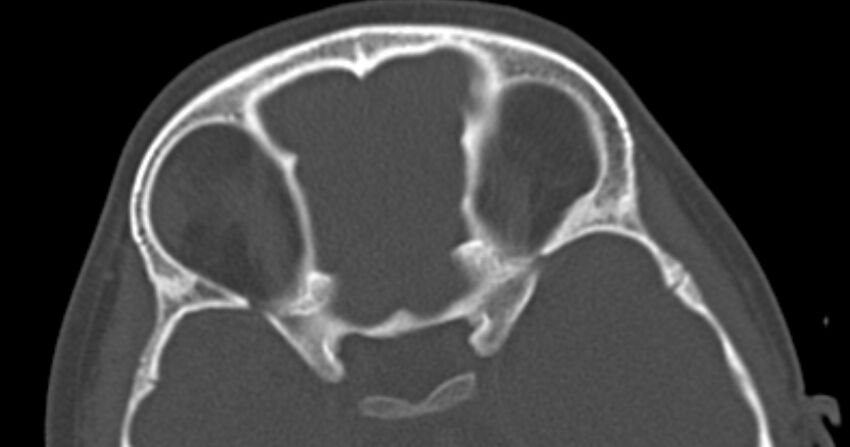 Choanal atresia (Radiopaedia 51295-56972 Axial bone window 60).jpg