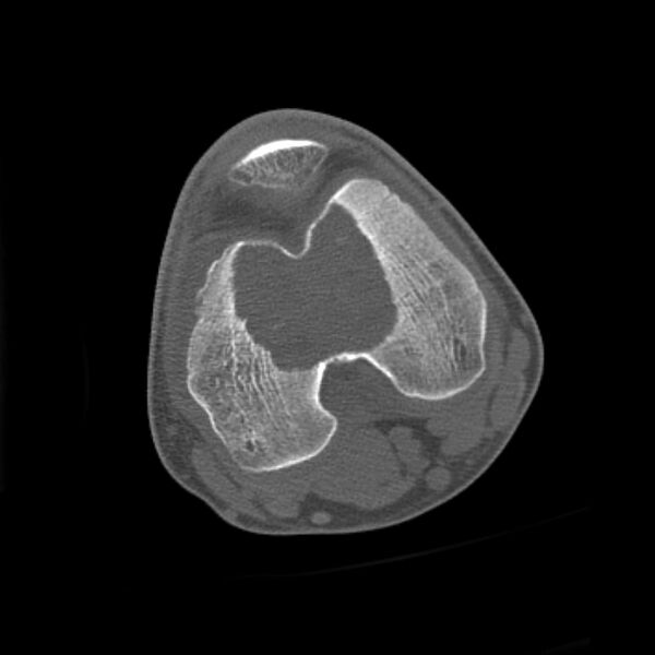 File:Chondroblastoma - distal femur (Radiopaedia 8112-8950 Axial bone window 1).jpg