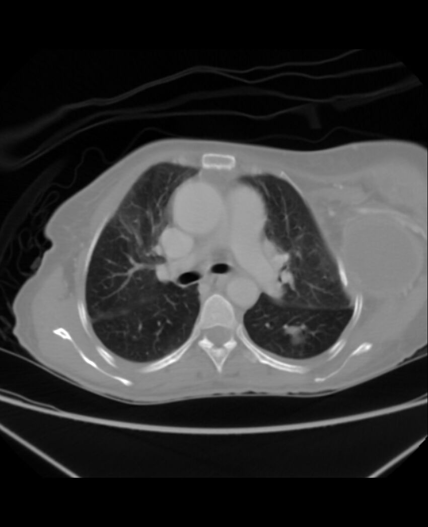 Chondrosarcoma (Radiopaedia 79427-92535 Axial lung window 20).jpg