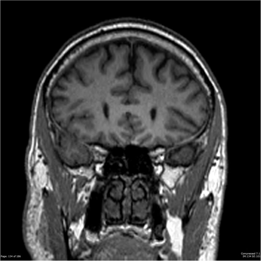 Chondrosarcoma of skull base- grade II (Radiopaedia 40948-43654 Coronal T1 55).jpg