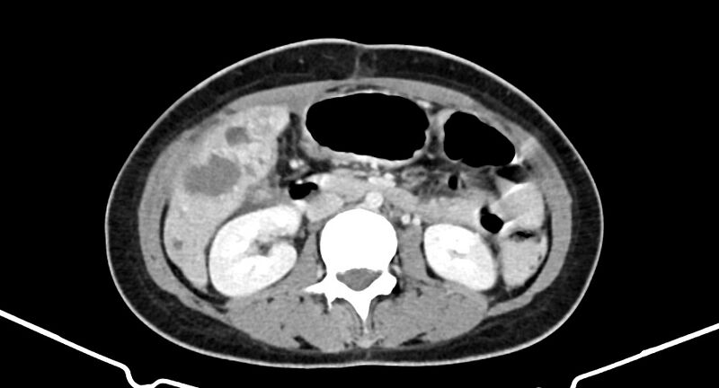 File:Choriocarcinoma liver metastases (Radiopaedia 74768-85766 A 104).jpg