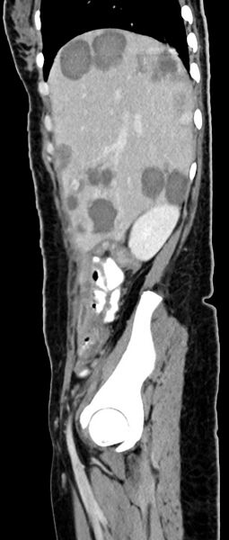 File:Choriocarcinoma liver metastases (Radiopaedia 74768-85766 C 133).jpg