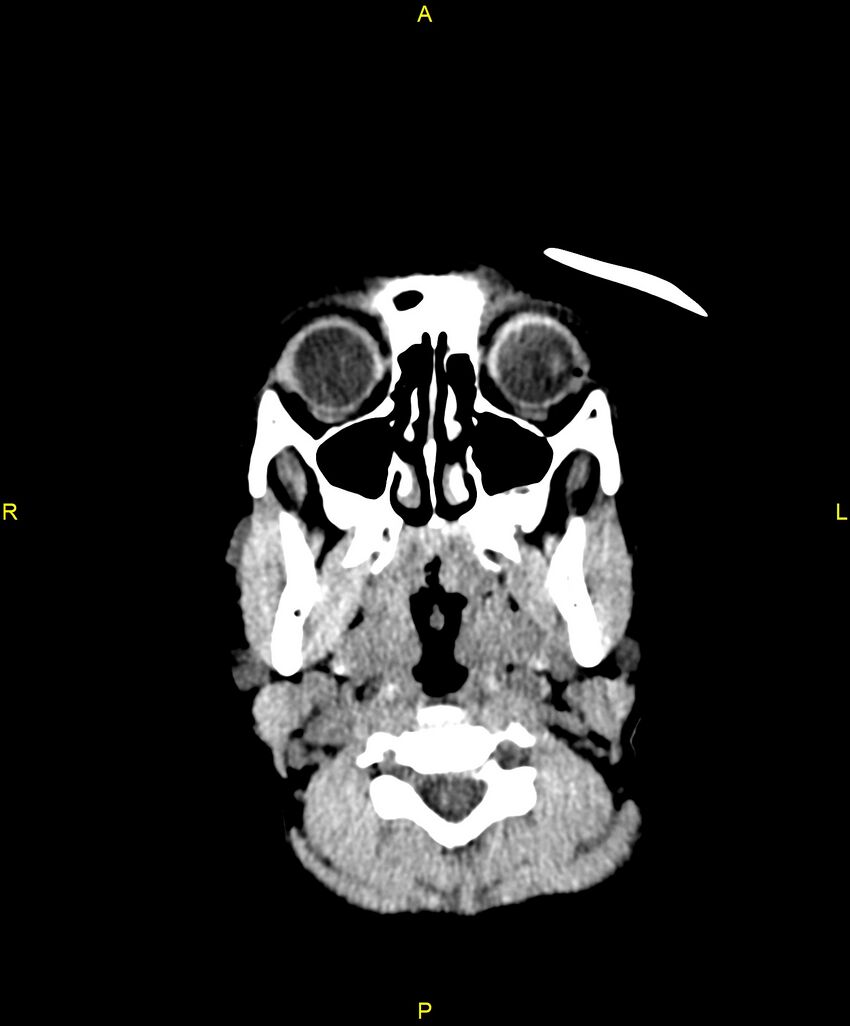 Choroidal fissure cyst (Radiopaedia 89481-106465 Axial non-contrast 1).jpg