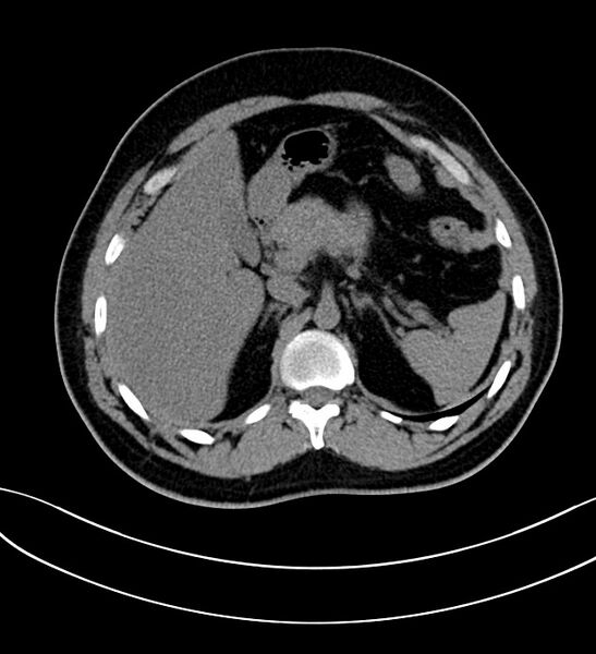 File:Chromophobe renal cell carcinoma (Radiopaedia 84286-99573 Axial non-contrast 11).jpg