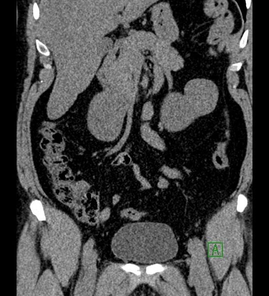 File:Chromophobe renal cell carcinoma (Radiopaedia 84286-99573 Coronal non-contrast 73).jpg
