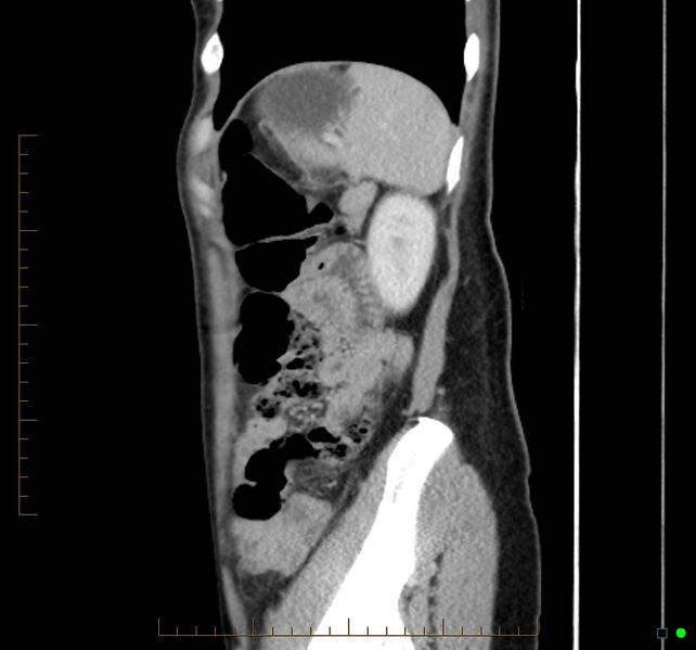 File:Chronic abscess due to "dropped" appendicoliths following appendectomy for perforated appendix (Radiopaedia 58805-66344 D 12).jpg
