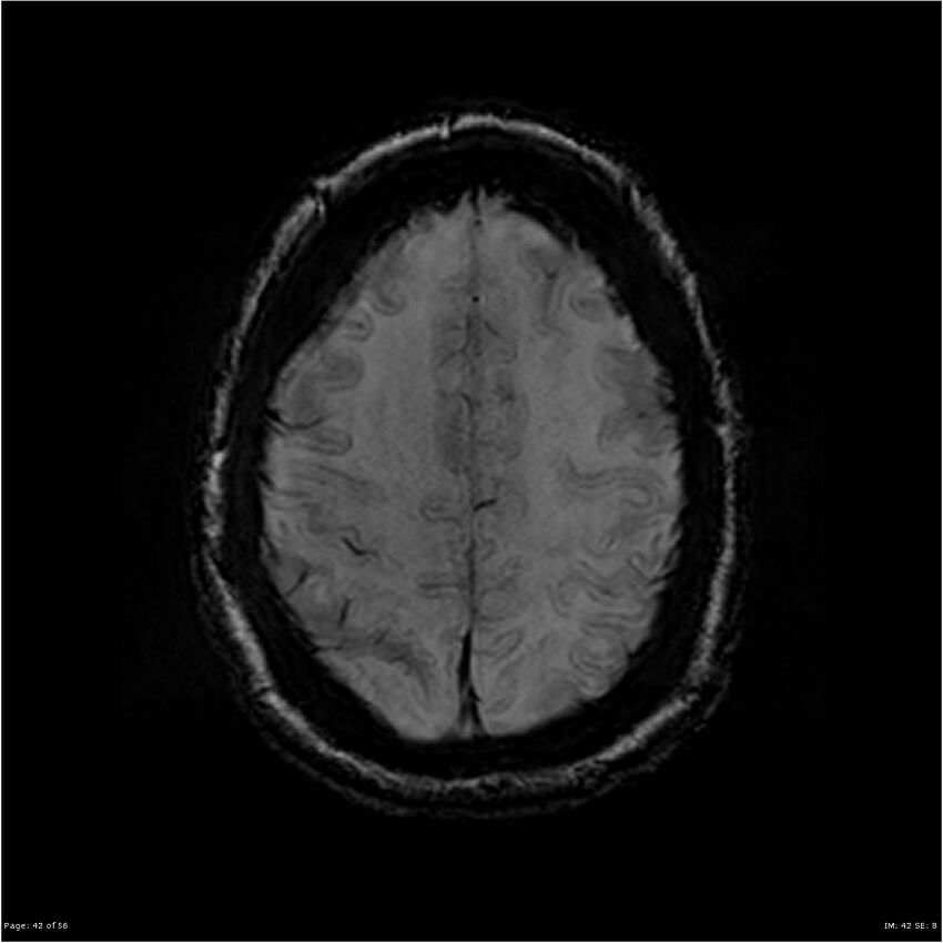 Chronic hypertensive encephalopathy (Radiopaedia 25764-25918 Axial SWI 42).jpg